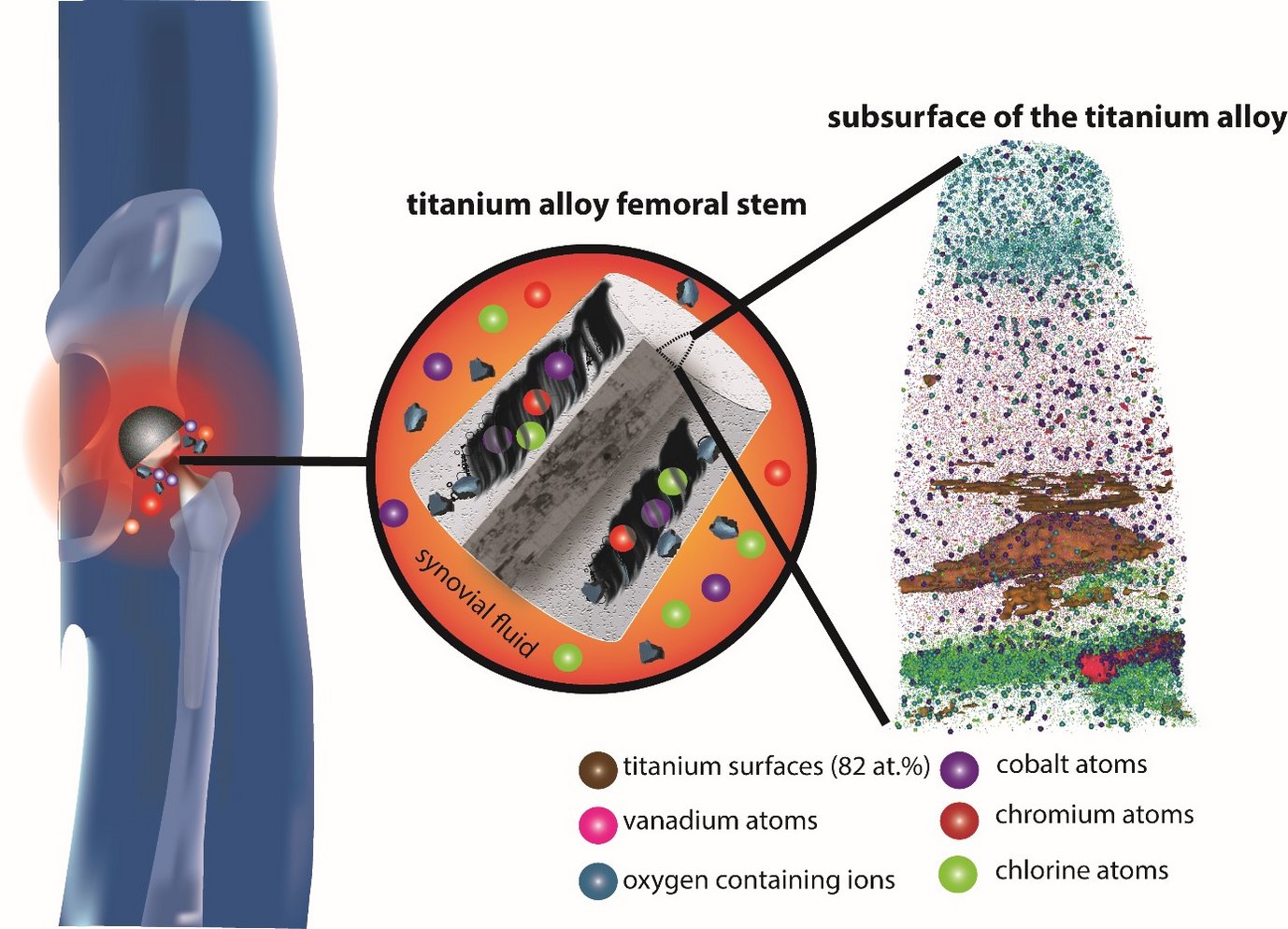 The titanium alloy hip stem used in total hip replacements, when coupled with a cobalt alloy femoral head, can degrade in the body due to fretting corrosion. From the atom probe tomography reconstruction of the subsurface of the titanium alloy (on the right), the MPIE scientists discovered that surface and subsurface oxides, fragmented titanium particles, the constituent elements of the cobalt alloy (cobalt, chromium) and the interfacial medium (chlorine) are incorporated.